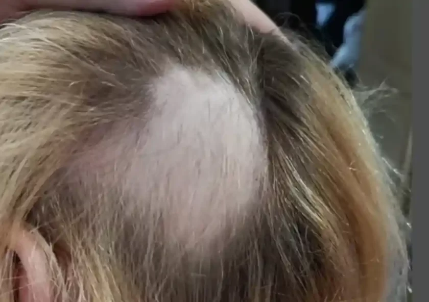 Denuncian brutal ataque en Esperanza: joven le arranca el pelo a un niño de 6 años con discapacidad Denuncian brutal ataque en Esperanza: joven le arranca el pelo a un niño de 6 años con discapacidad