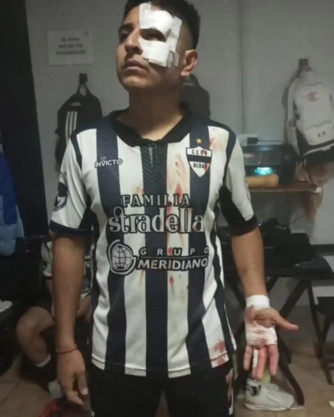 Agresión brutal en partido de Liga Rafaelina: Jugador de Aldao sufrió patada en la cabeza y recibió puntos de sutura Agresión brutal en partido de Liga Rafaelina: Jugador de Aldao sufrió patada en la cabeza y recibió puntos de sutura